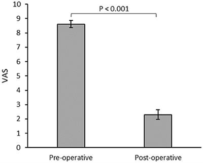 Spinal Cord Stimulation as an Alternative to Opioid for Axial Neck and Back Pain: A Case Series